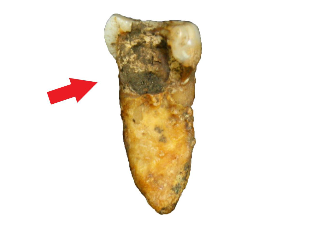 Caries en primer molar inferior derecho